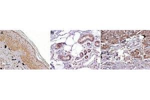 Expression of MC1R in normal skin and melanoma - Immunohistochemical staining of paraffin embedded normal skin and melanoma sections using Anti-MC1 Receptor Antibody (ABIN7043321, ABIN7044592 and ABIN7044593) (1:100). (MC1 Receptor 抗体  (AA 217-232))