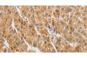 Immunohistochemistry of paraffin-embedded Human liver cancer tissue using ARHGAP5 Polyclonal Antibody at dilution 1:30 (ARHGAP5 抗体)
