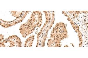 Immunohistochemistry of paraffin-embedded Human thyroid cancer tissue using LGALS4 Polyclonal Antibody at dilution of 1:30(x200) (GAL4 抗体)