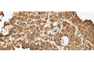 Immunohistochemistry of paraffin-embedded Human ovarian cancer tissue using RBL2 Polyclonal Antibody at dilution of 1:45(x200)