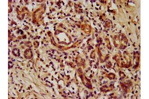 IHC image of ABIN7172763 diluted at 1:1000 and staining in paraffin-embedded human pancreatic cancer performed on a Leica BondTM system. (TEAD3 抗体  (AA 112-435))