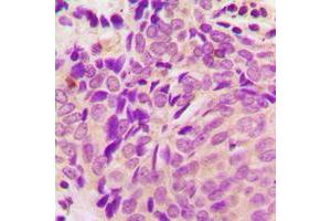 Immunohistochemical analysis of Beta-tubulin staining in human breast cancer formalin fixed paraffin embedded tissue section. (TUBB 抗体  (C-Term))
