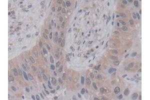 DAB staining on IHC-P; Samples: Human Lung cancer Tissue (PPIA 抗体  (AA 2-165))