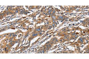 Immunohistochemistry of paraffin-embedded Human gastric cancer using GNA13 Polyclonal Antibody at dilution of 1:30 (GNA13 抗体)
