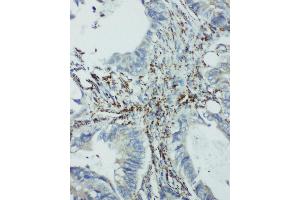 Anti-integrin beta 4 binding protein antibody, IHC(P) IHC(P): Human Intestinal Cancer Tissue (EIF6 抗体  (Middle Region))
