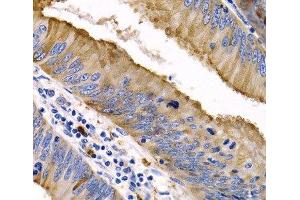 Immunohistochemistry of paraffin-embedded Human colon cancer using IL9 Polyclonal Antibody at dilution of 1:200 (40x lens). (IL-9 抗体)
