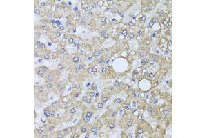 Immunohistochemistry of paraffin-embedded human liver injury using AARS2 antibody.