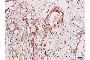 Formalin-fixed and paraffin embedded human breast cancer labeled with Anti-CA153/MUC1/KL-6 Polyclonal Antibody, Unconjugated (ABIN687367) at 1:200 followed by conjugation to the secondary antibody and DAB staining. (MUC1 抗体  (AA 1101-1255))