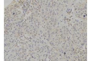 ABIN6272856 at 1/100 staining Human breast cancer tissue by IHC-P. (Caprin-1 抗体  (Internal Region))