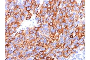Formalin-fixed, paraffin-embedded human Melanoma stained with MART-1 / Melan-A Monoclonal Antibody (A103+M2-7C10+M2-9E3). (MLANA 抗体)