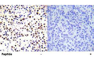 Immunohistochemical analysis of paraffin-embedded human malignant lymphoma tissue using HIST1H3E (phospho T3) polyclonal antibody . (HIST1H3E 抗体  (pThr3))