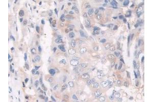 Detection of GLa in Human Breast cancer Tissue using Polyclonal Antibody to Galactosidase Alpha (GLa)