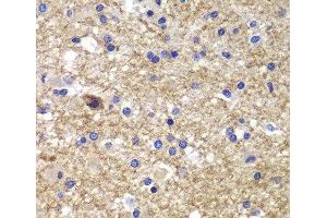 Immunohistochemistry of paraffin-embedded Human brain cancer using CDK6 Polyclonal Antibody at dilution of 1:100 (40x lens). (CDK6 抗体)