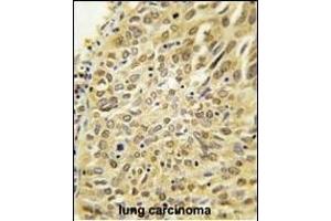 Formalin-fixed and paraffin-embedded human lung carcinoma tissue reacted with Dsk2 Antibody (N-term) (ABIN388963 and ABIN2839210) , which was peroxidase-conjugated to the secondary antibody, followed by DAB staining. (Ubiquilin 1 抗体  (N-Term))