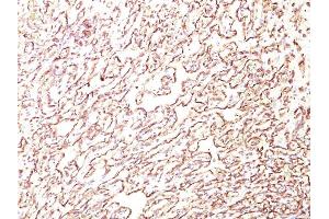 Formalin-fixed, paraffin-embedded human Angiosarcoma stained with Podocalyxin Monoclonal Antibody (4F10). (PODXL 抗体  (Extracellular Domain))