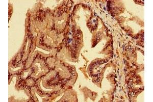 Immunohistochemistry of paraffin-embedded human prostate cancer using ABIN7151962 at dilution of 1:100 (EPN3 抗体  (AA 25-208))