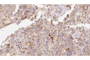 ABIN6278123 at 1/100 staining Human Melanoma tissue by IHC-P.