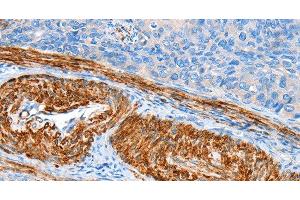 Immunohistochemistry of paraffin-embedded Human cervical cancer tissue using AARS Polyclonal Antibody at dilution 1:60 (AARS 抗体)