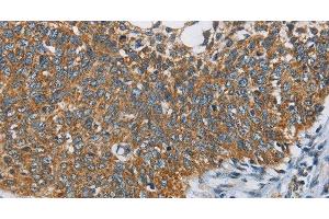 Immunohistochemistry of paraffin-embedded Human cervical cancer tissue using ANKHD1 Polyclonal Antibody at dilution 1:40 (ANKHD1 抗体)