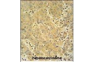 CYP2A7 antibody (Center) (ABIN654434 and ABIN2844170) immunohistochemistry analysis in formalin fixed and paraffin embedded human hepatocarcinoma followed by peroxidase conjugation of the secondary antibody and DAB staining. (CYP2A7 抗体  (AA 121-148))