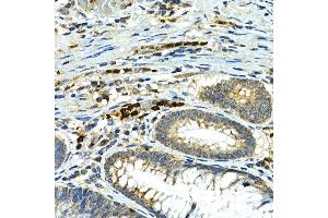 Immunohistochemistry of paraffin-embedded human colon carcinoma using MMP9 Rabbit pAb (ABIN6134758, ABIN6143921, ABIN6143924 and ABIN6215080) at dilution of 1:100 (40x lens).
