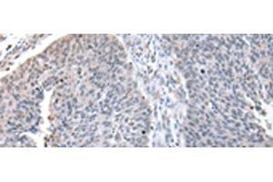 Immunohistochemistry of paraffin-embedded Human lung cancer tissue using ZNF23 Polyclonal Antibody at dilution of 1:50(x200) (ZNF23 抗体)