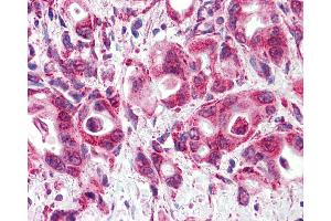 Anti-GLP1R/GLP-1R/GLP-1 Receptor antibody IHC of human Pancreas, Carcinoma. (GLP1R 抗体  (N-Term))