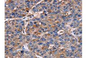 The image on the left is immunohistochemistry of paraffin-embedded Human liver cancer tissue using ABIN7130450(NPM3 Antibody) at dilution 1/60, on the right is treated with fusion protein. (NPM3 抗体)