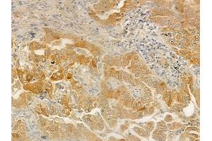 ABIN6259517 and ABIN6275666 at 1/100 staining human lung adenocarcinoma by IHC-P.