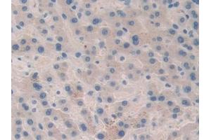 Detection of F5 in Human Liver cancer Tissue using Polyclonal Antibody to Coagulation Factor V (F5) (Coagulation Factor V 抗体  (AA 463-715))