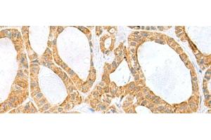 Immunohistochemistry of paraffin-embedded Human thyroid cancer tissue using PPIH Polyclonal Antibody at dilution of 1:60(x200) (PPIH 抗体)