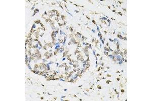 Immunohistochemistry of paraffin-embedded human esophageal cancer using PSMB1 antibody. (PSMB1 抗体  (AA 29-241))