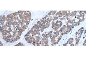 Immunohistochemistry of paraffin-embedded Human esophagus cancer tissue using CNTN1 Polyclonal Antibody at dilution of 1:35(x200) (Contactin 1 抗体)