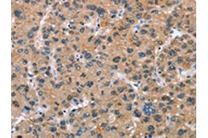 The image on the left is immunohistochemistry of paraffin-embedded Human liver cancer tissue using ABIN7189673(ADGRB2 Antibody) at dilution 1/25, on the right is treated with synthetic peptide. (BAI2 抗体)