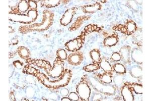 IHC testing of FFPE human renal cell carcinoma with recombinant Cadherin 16 antibody (clone CDH16/1532R). (Recombinant Cadherin-16 抗体)