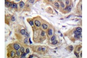 Immunohistochemistry analyzes of ErbB-3 antibody in paraffin-embedded human breast carcinoma tissue. (ERBB3 抗体)
