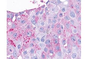 Anti-TAAR9 antibody IHC of human Breast, Carcinoma. (TAAR9 抗体  (C-Term))