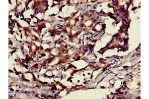 Immunohistochemistry of paraffin-embedded human gastric cancer using ABIN7155201 at dilution of 1:100 (HMGB1 抗体  (AA 2-215))