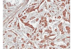 IHC-P Image Immunohistochemical analysis of paraffin-embedded human breast cancer, using TULP1, antibody at 1:100 dilution. (TULP1 抗体)