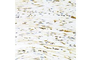 Immunohistochemistry of paraffin-embedded human colon carcinoma using MDM2 Antibody  at dilution of 1:200 (40x lens).