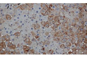 Immunohistochemistry of paraffin-embedded Human thyroid cancer tissue using MPO Polyclonal Antibody at dilution 1:50 (Myeloperoxidase 抗体)