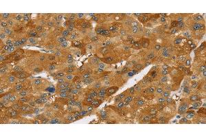 Immunohistochemistry of paraffin-embedded Human liver cancer using TNFSF15 Polyclonal Antibody at dilution of 1:40 (TNFSF15 抗体)