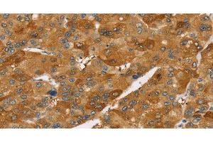 Immunohistochemistry of paraffin-embedded Human liver cancer using TNFSF15 Polyclonal Antibody at dilution of 1:40 (TNFSF15 抗体)
