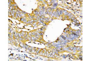 Anti-Caspase-1(P20) antibody, IHC(P) IHC(P): Human Mammary Cancer Tissue (Caspase 1 抗体  (N-Term))