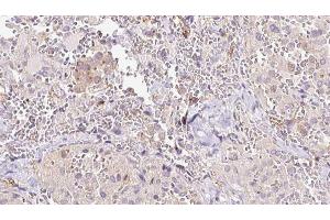 ABIN6273310 at 1/100 staining Human thyroid cancer tissue by IHC-P. (RLBP1 抗体  (Internal Region))