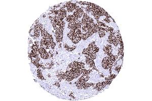 Breast Breast cancer of no special type NST HER2 (Recombinant ErbB2/Her2 抗体  (Extracellular Domain))