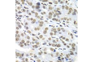 Immunohistochemistry of paraffin-embedded human gastric cancer using HDAC2 antibody (ABIN5971110) at dilution of 1/100 (40x lens). (HDAC2 抗体)