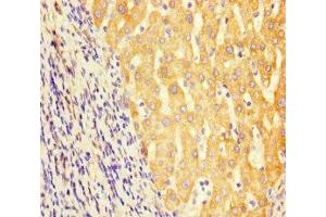 Immunohistochemistry of paraffin-embedded human liver cancer using ABIN7154056 at dilution of 1:100 (GCDH 抗体  (AA 45-300))