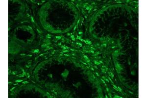 Formalin-fixed and paraffin embedded human colon carcinoma tissue labeled with Anti-Phospho-IKK alpha/beta (Ser176/Ser180) Polyclonal Antibody, Unconjugated  at 1:200 followed by conjugation to the secondary antibody, Goat Anti-Rabbit IgG, FITC conjugated-FITC). (IKK-alpha /IKK-beta 抗体  (pSer176, pSer180))