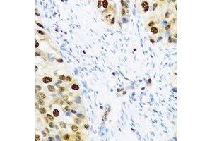 Immunohistochemical analysis of SLM-1 staining in human prostate cancer formalin fixed paraffin embedded tissue section. (KHDRBS2 抗体)